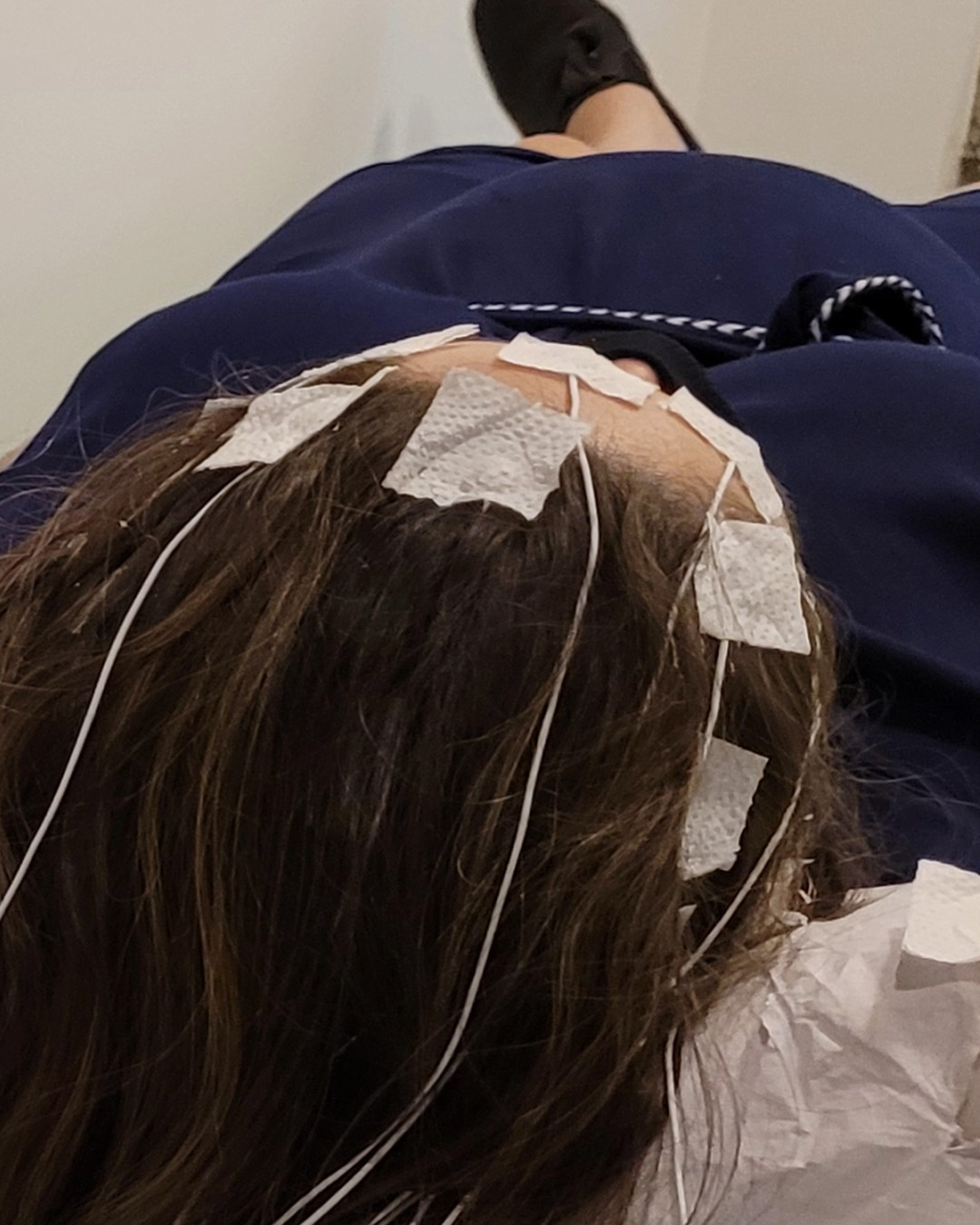 Eletrodos posicionados no couro cabeludo durante EEG